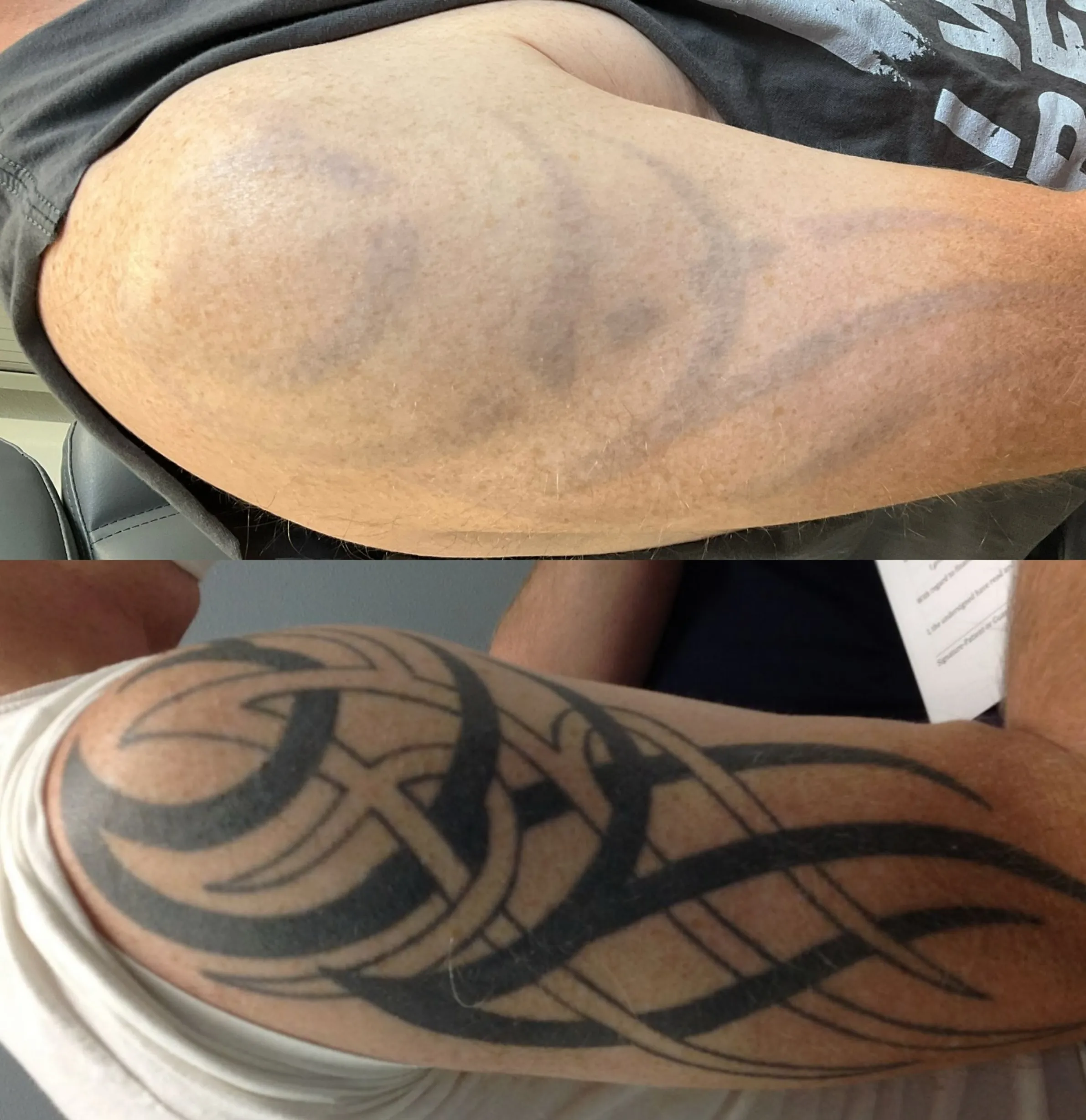 tattoo removal price per session
