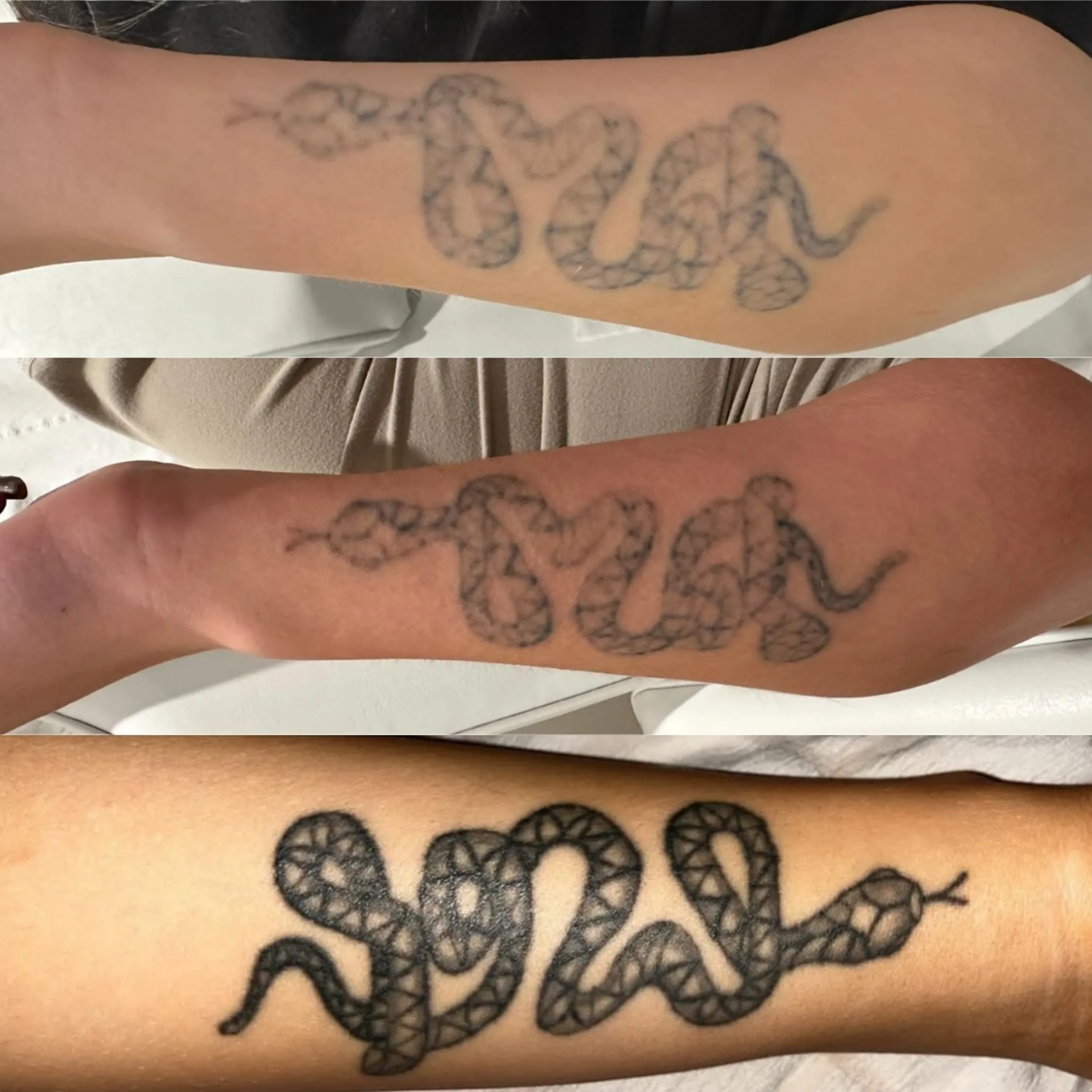 saline vs laser tattoo removal