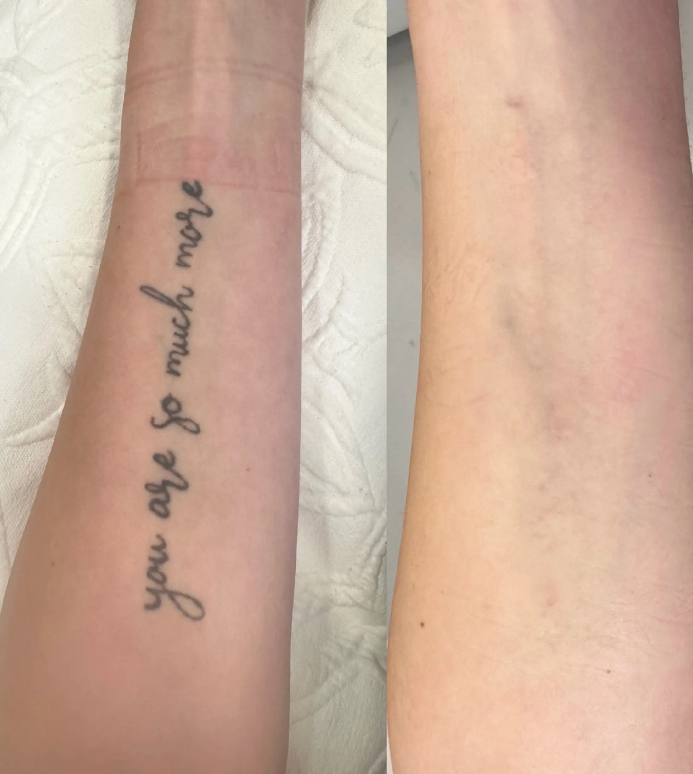 cosmetic tattoo removal Brisbane