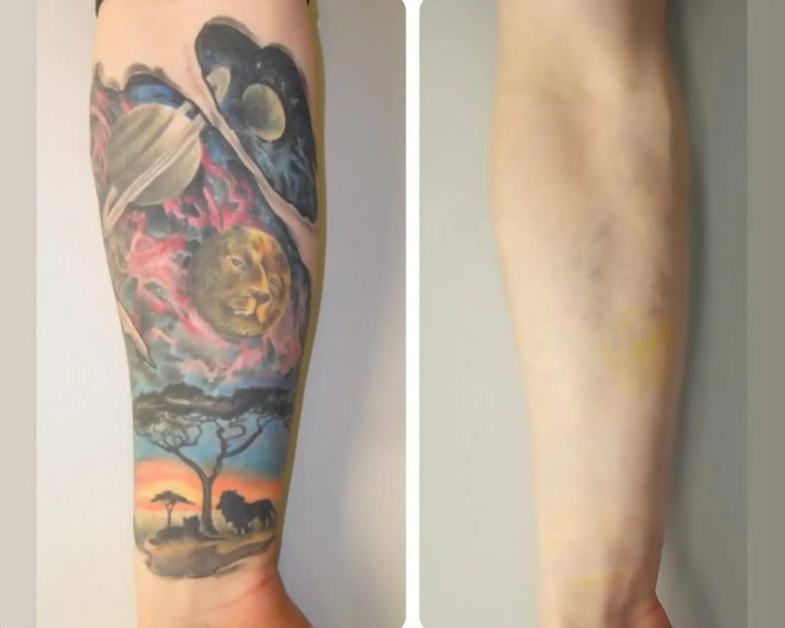 eyebrow tattoo removal price