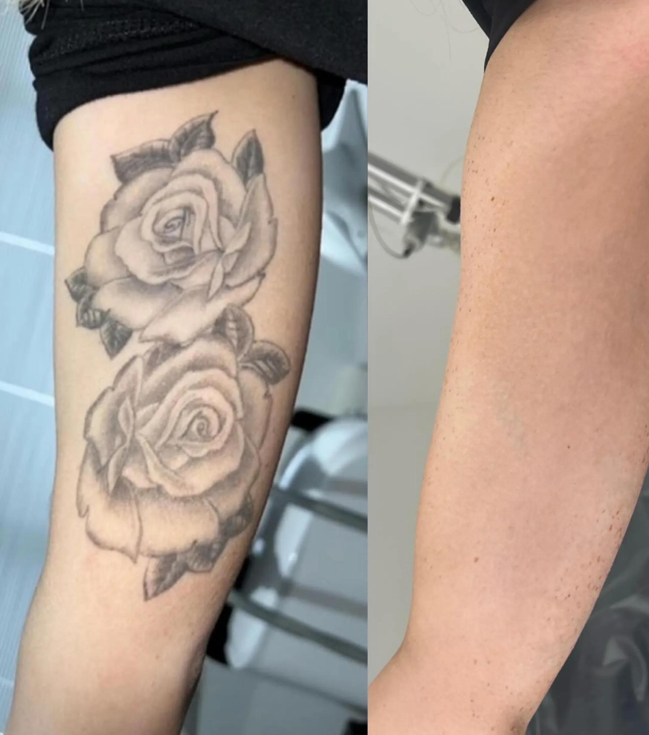 how much is laser tattoo removal