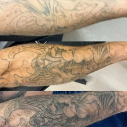 tattoo removal cost Brisbane