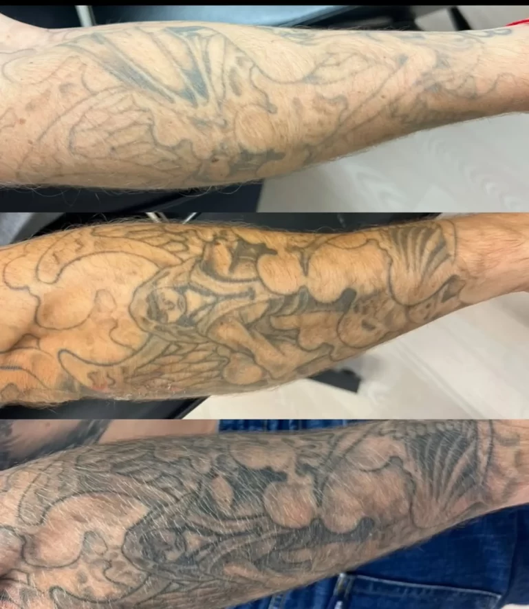 tattoo removal cost Brisbane